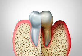 Image result for Periodontitis