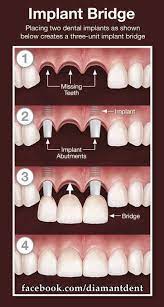 Pin On Implants