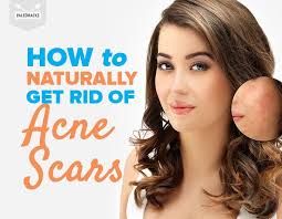 Some face the annoying and ugly acne. How To Naturally Get Rid Of Acne Scars With Oils And Home Remedies