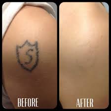 Safe and effective tattoo removal takes time. Laser Tattoo Removal Before And After Photos