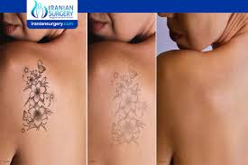 The dermatologic surgeon removes the tattoo using a scalpel and closes the wound with stitches. Tattoo Removal Iranian Surgery