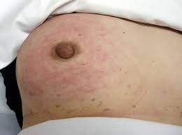 The pain may be constant or it may occur only occas. Inflammatory Breast Cancer Symptoms And Treatment Health Com