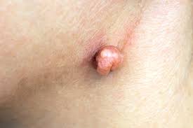 Hpv é a sigla de human papiloma virus ou vírus do papiloma humano. Hpv Confira Os Sintomas As Causas E Onde Fazer O Tratamento