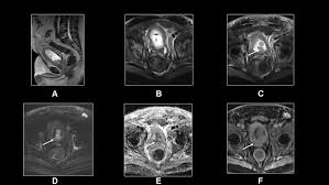 Image result for Prostate Cancer Staging