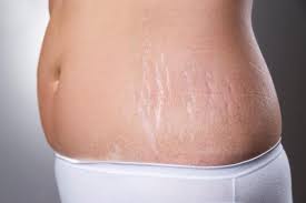 Stretch Mark Removal: Treatments And Home Remedies