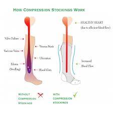 Prevent Deep Venous Thrombosis Medical Compression Stockings With Zipper Buy Medical Compression Stockings Compression Stocking With Zipper Medical Stocking Product On Alibaba Com