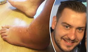 Father hospitalised with viral meningitis from false widow spider bite