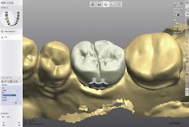 References In Design Concept For Preventing Aspiration Or Ingestion Of Cad Cam Crowns A Dental Technique Journal Of Prosthetic Dentistry