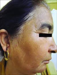 Image result for Diffuse Hyperpigmentation