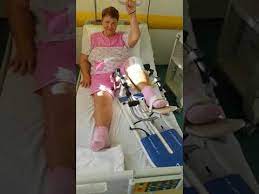 Operatia de proteza de genunchi nu este complicata, dar succesul operatiei depinde de experienta chirurgului ortoped care o realizeaza. Pacienta Proteze Genunchi 6 Zile De La Operatie Partea 1 Youtube