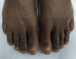 Image result for Onycholysis feet