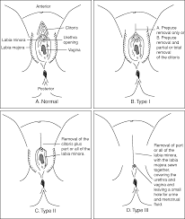 It involves the partial or total removal of the external female genitalia. Female Genital Mutilation Chapter 18 Forensic Gynaecology