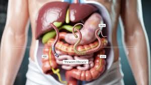 Image result for Pinworm