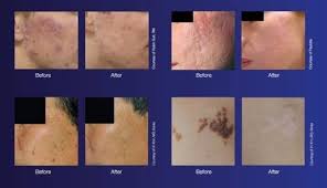 Klinik pakar kulit perdana in kota bharu, malaysia. Rawatan Di Ay Skin Specialist Clinic Buat Muka Flawless Sebelum Raya