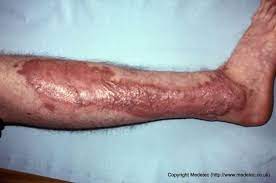Skin Grafts Split Thickness And Full Thickness Woundsource