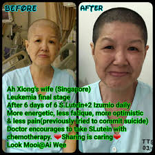 Tubuh akan menampung sekitar 50 persen volume darah. Leukemia Penyakit Kanser Darah Nutrion Terbaik Untuk Kesihatan