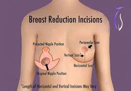 How to get insurance to pay for breast reduction. Breast Reduction Newport Beach La Jolla San Diego Tim Sayed Md Facs