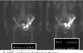 In other cases, it may be more aggressive. Figure 3 From Paget S Disease Mimicking Metastatic Prostate Cancer On Bone Scan Image A Case Report Semantic Scholar
