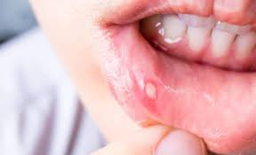 Our cancer doctors use a variety of diagnostic tests to evaluate oral cancer and develop an individualized treatment plan. Mouth Ulcers Causes Symptoms And Treatment
