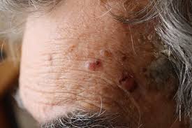 Basal cell skin cancer (bcc): Skin Cancers On Forehead Dermoscopy