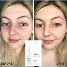 The ordinary alpha arbutin 2% + hyaluronic acid serum reduces the looks of spots and alpha arbutin is much stronger in effect than arbutin or beta arbutin. Hyaluronic Acid The Ordinary Before And After Hydroponics And Aquaponics Tips And Tricks