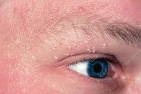 Image result for milium cyst on eyelid