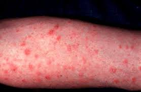 In der kindheit nur einmal gegen masern geimpft wurden, eine impfung gegen masern. Roschenflechte Pityriasis Rosea Deximed