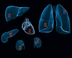 Image result for Transplant Rejection