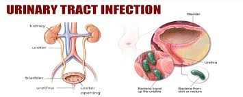 Sistem urinary adalah sistem organ yang memproduksi uretra merupakan saluran yang membawa urine keluar dari vesica urinaria menuju lingkungan luar. Apa Yang Dimaksud Dengan Infeksi Saluran Kemih Ilmu Kedokteran Dictio Community