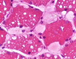 Present in the brush border of the intestinal mucosal maltase. a dictionary of food and nutrition. Acid Maltase Pathology