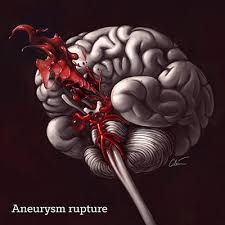 About 10% of patients with a ruptured aneurysm die before receiving medical care. An Introduction To Brain Aneurysms Brainbook