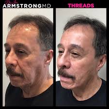 Say hello to the Armstrong MD Body Laser — the first of its kind! This  revolutionary treatment targets crepey skin, improves texture, tightens,  and evens skin tone — all in one. Ready