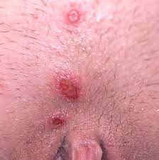 Is This Herpes Or Infected Ingrown Hairs Please Help I M Freaking Out Genital Herpes Simplex Forums Patient