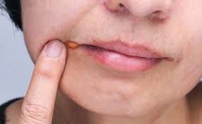 Image result for Angular Stomatitis