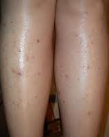 Endogal Com On Twitter Bacak Koltukalti Ve Bikini Bolgesinde Kil Batiklari Mi Var 1 5 Etkili Dephyto Milano Pft Https T Co Knqubkbgea Https T Co Ommygxd8f9