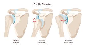Image result for Shoulder Relocation Maneuvers