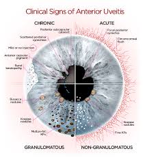What they have in common is eye that destruction can lead to poor vision or blindness. Anterior Uveitis Diagram Png 500 558 Uveitis Optometry Education Eye Facts