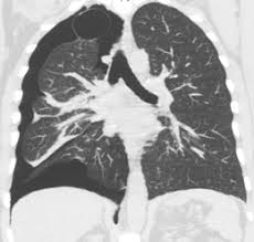 Check spelling or type a new query. Pneumothorax Wikipedia