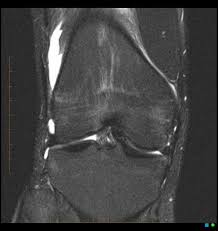 Bucket Handle Tear Medial Meniscus Radiology Case Radiopaedia Org Radiology Meniscal Tear Tears