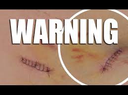 24.05.2017 · northwell health dermatologist & mohs skin cancer surgeon dr. Warning Graphic Content My Skin Cancer Scare Youtube