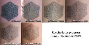 In particular if you have also suffered from ingrown hairs it may be those areas which are particularly itchy. 4th And 5th Treatments Ink Regret