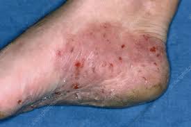 Image result for pompholyx soles of feet