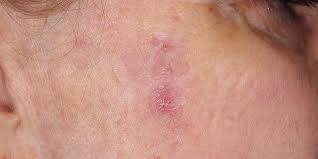 They can also develop in scars or skin sores elsewhere. Actinic Keratosis Skin Cancer And Reconstructive Surgery Center