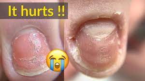 Badly Damaged Nails Transformation With Acrylic Youtube