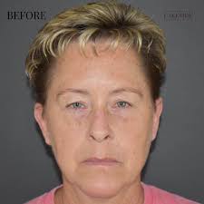 Check out this lovely patient's journey the week following her upper eyelid  lift. This was done in a 1 hour procedure in the office. She couldn't  believe how easy the procedure and