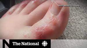 But as experts began to better understand the disease, it became clear. Children May Show Covid 19 Symptoms On Their Feet Youtube