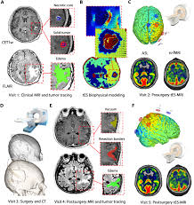 How common are brain tumors? Reduction Of Intratumoral Brain Perfusion By Noninvasive Transcranial Electrical Stimulation Science Advances