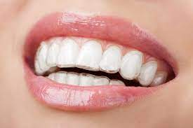 Shoppe deine lieblingstrends von reima online im shop. Estetica Dentale La Mascherina Invisibile Meglio Dell Apparecchio