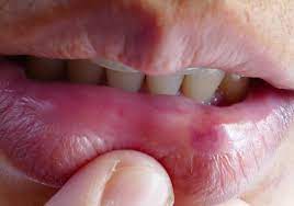 Busted Lip: 9 Treatments And Home Remedies