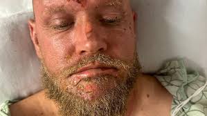 Sandy man remains in hospital after camping trailer explodes multiple times 